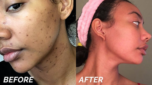 Dark Spot Remover - MIRACLE in a Bottle - Hyperpigmentation Fix VIP