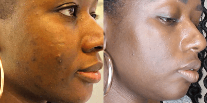 DARK SPOT REMOVER SERUM 