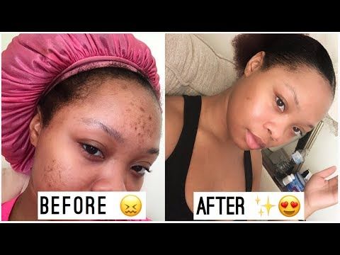 Dark Spot Remover - MIRACLE in a Bottle - Hyperpigmentation Fix VIP