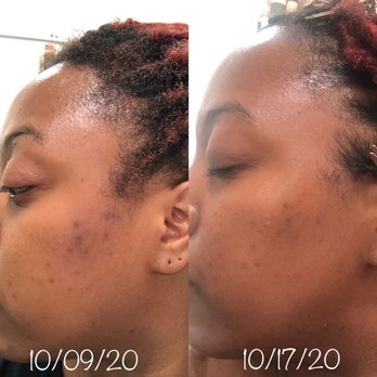 DARK SPOT REMOVER 