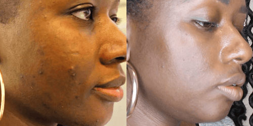 Dark Spot Remover - MIRACLE in a Bottle - Hyperpigmentation Fix